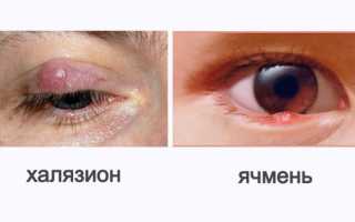 Обзор эффективных мазей от халязиона верхнего века