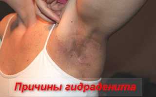 Сучье вымя (гидраденит): фото, как лечить под мышкой, в паху