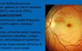 Окклюзия центральной артерии сетчатки глаза – лечение