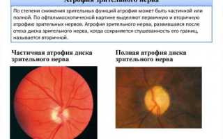 Как вытащить ресницу из глаза, если ее не видно? Инструкция и способы