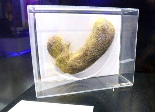 Трихобезоары