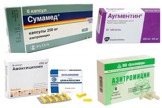 Эффективные лекарства от горла в виде антибиотиков Эффективные лекарства от горла в виде антибиотиков