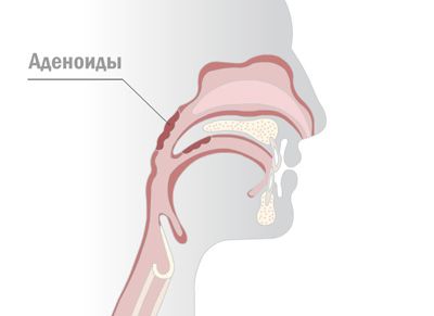 Где находятся аденоиды? Где находятся аденоиды?