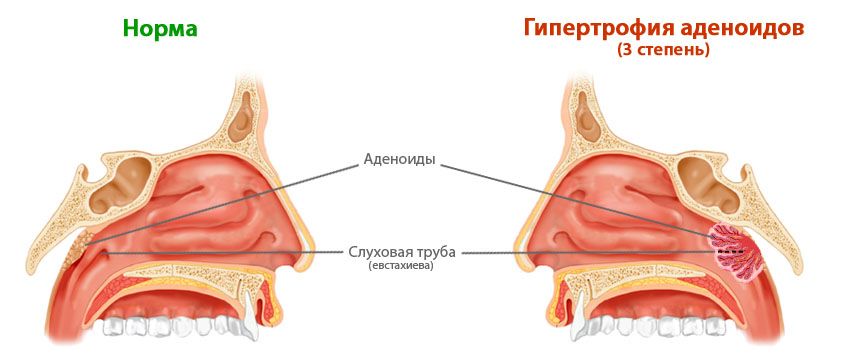 Гипертрофия аденоидов третьей степени требует оперативного вмешательства. Гипертрофия аденоидов третьей степени требует оперативного вмешательства.