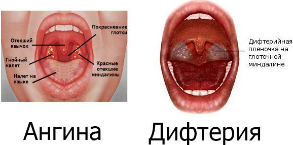 Гнойничок на горле не всегда свидетельствует о наличии ангины, иногда это признак дифтерии. Гнойничок на горле не всегда свидетельствует о наличии ангины, иногда это признак дифтерии.