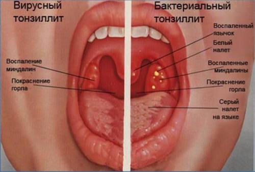 Характерные признаки вирусного и бактериального тонзиллита Характерные признаки вирусного и бактериального тонзиллита