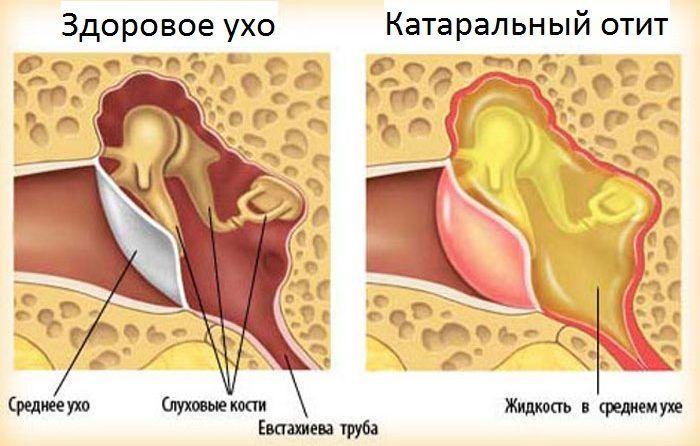 Катаральный Катаральный