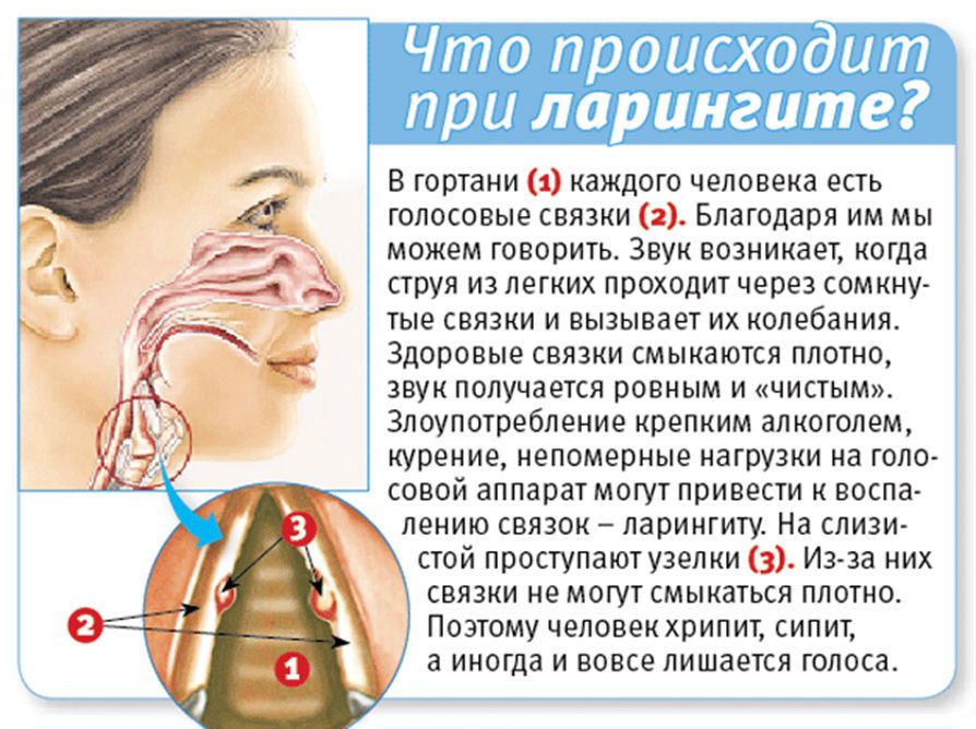 Ларингит – это заболевание, вызывающее нарушение работы голосовых связок. Ларингит – это заболевание, вызывающее нарушение работы голосовых связок.