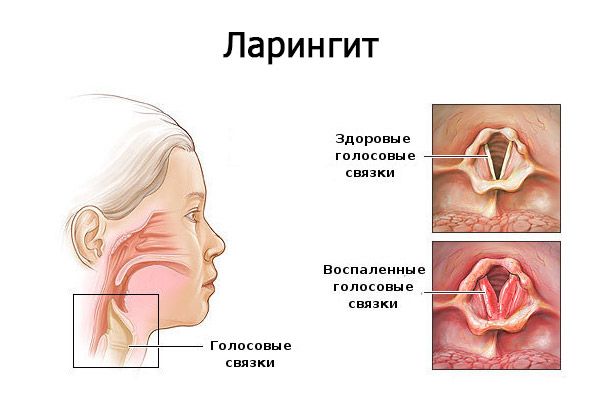 Ларингит острый и хронический – повод обратиться к врачу Ларингит острый и хронический – повод обратиться к врачу