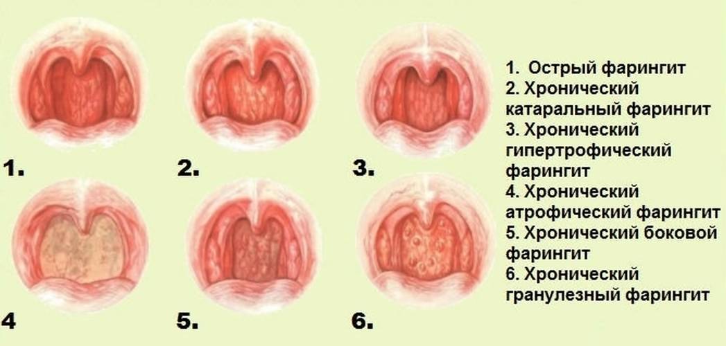 Лечение хронического воспалительного процесса назначается только после уточнения формы заболевания (на фото) – самолечение в данном случае крайне опасно. Лечение хронического воспалительного процесса назначается только после уточнения формы заболевания (на фото) – самолечение в данном случае крайне опасно.