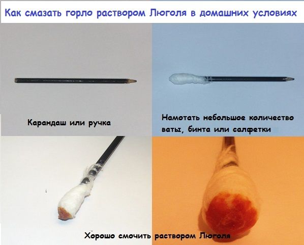Люголь детям при ангине раньше наносили турундами, сделанными своими руками с помощью карандаша Люголь детям при ангине раньше наносили турундами, сделанными своими руками с помощью карандаша