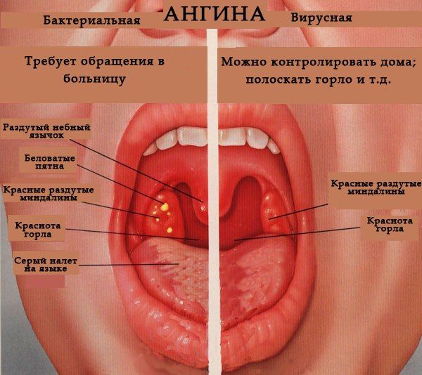 На фото наглядно показана разница в видах ангины На фото наглядно показана разница в видах ангины