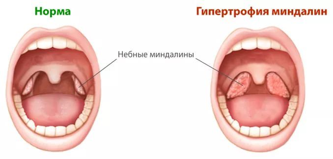 Нёбные миндалины, самые известные из всех Самые известные из всех
