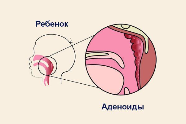 Носоглоточная миндалина находятся на задне-верхней стенке носоглотки и не видна при обычном осмотре зева Носоглоточная миндалина находятся на задне-верхней стенке носоглотки и не видна при обычном осмотре зева