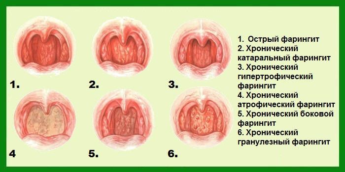 Определить характер заболевания можно, осмотрев горло малыша Определить характер заболевания можно, осмотрев горло малыша