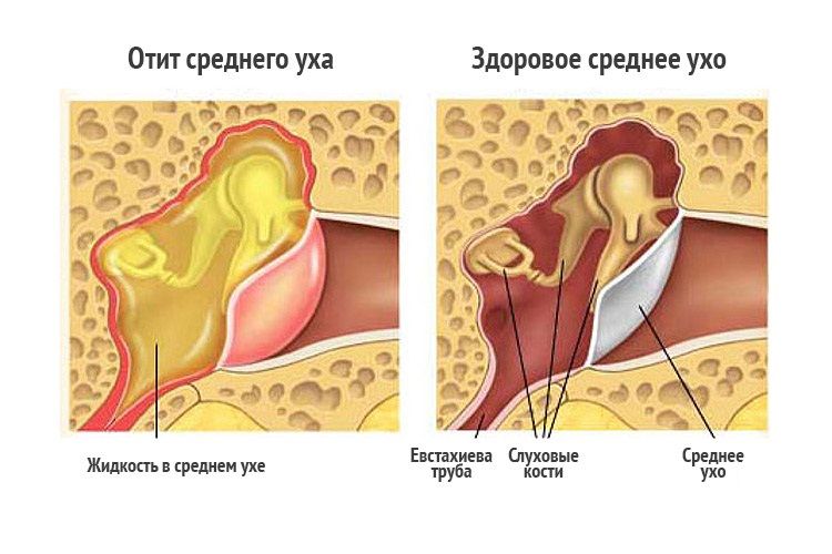 Отит – распространенное заболевание в ЛОР практике Отит – распространенное заболевание в ЛОР практике