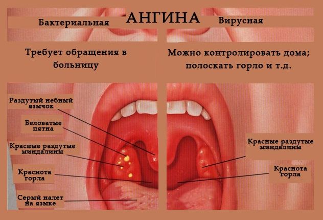 Отличия бактериальной и вирусной ангины Отличия бактериальной и вирусной ангины