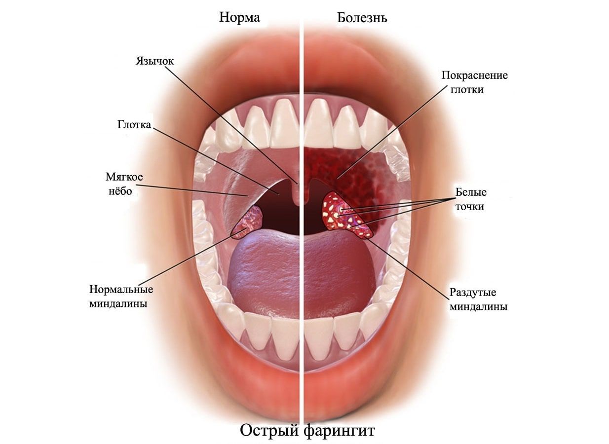 При красном горле, жалобах на резкую боль, высокой температуре, налетах на миндалинах (фото) — можно предположить вирусную, бактериальную или грибковую инфекцию. При красном горле, жалобах на резкую боль, высокой температуре, налетах на миндалинах (фото) — можно предположить вирусную, бактериальную или грибковую инфекцию.