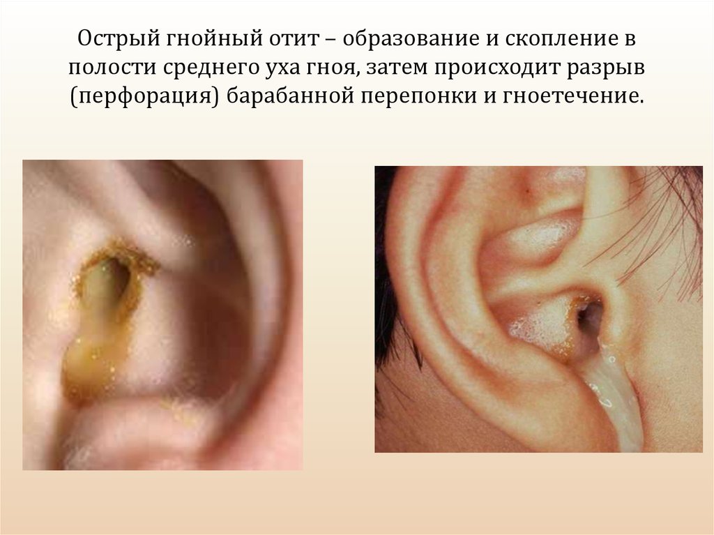 При попадании воды в среднее ухо могут развиваться гноеродные процессы При попадании воды в среднее ухо могут развиваться гноеродные процессы