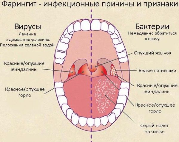 Распознать фарингит у ребенка можно по таким признакам. Распознать фарингит у ребенка можно по таким признакам.
