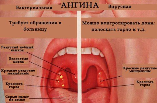 Различия бактериальной и вирусной ангины Различия бактериальной и вирусной ангины