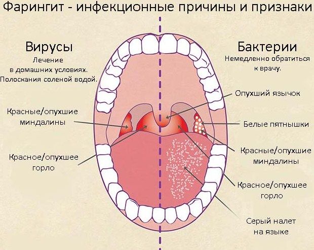 Различия между вирусной и бактериальной природой фарингита. Различия между вирусной и бактериальной природой фарингита.