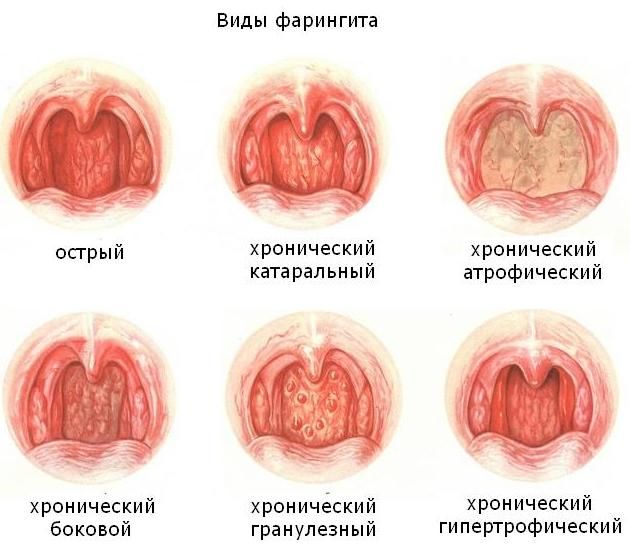 Разновидности фарингитов Разновидности фарингитов