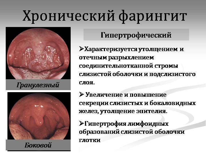Ринофарингит характеризуется соединением двух заболеваний ринита и фарингита. Ринофарингит характеризуется соединением двух заболеваний ринита и фарингита.