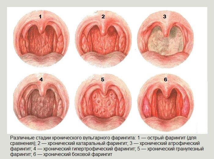 Стадии фарингита Стадии фарингита