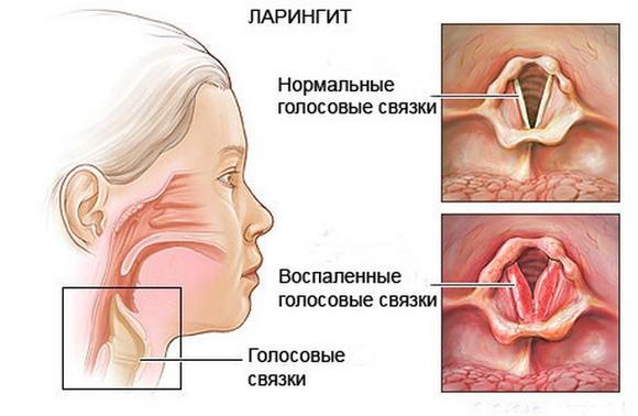 Так выглядят измененные воспалительным процессом голосовые связки (на фото) Так выглядят измененные воспалительным процессом голосовые связки (на фото)
