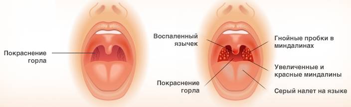 Улучшение клинической и фарингоскопической картины – признаки выздоровления. Улучшение клинической и фарингоскопической картины – признаки выздоровления.