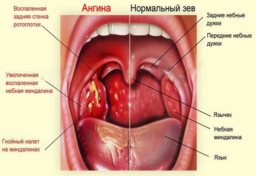 В большинстве случаев лакунарная ангина является продолжением фолликулярного тонзиллита - воспаление распространяется на лакуны миндалин и гной покрывает их полностью в виде рыхлых пленчатых налетов, которые легко снимаются шпателем без кровоточивости тканей (на фото) В большинстве случаев лакунарная ангина является продолжением фолликулярного тонзиллита - воспаление распространяется на лакуны миндалин и гной покрывает их полностью в виде рыхлых пленчатых налетов, которые легко снимаются шпателем без кровоточивости тканей (на фото)
