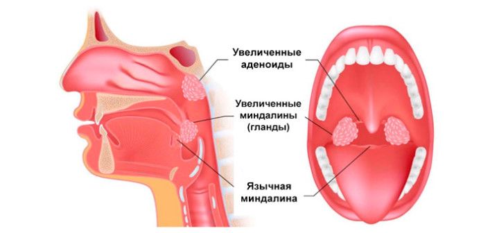 Взаимное расположение нёбных, глоточной и язычной миндалин Схема расположения